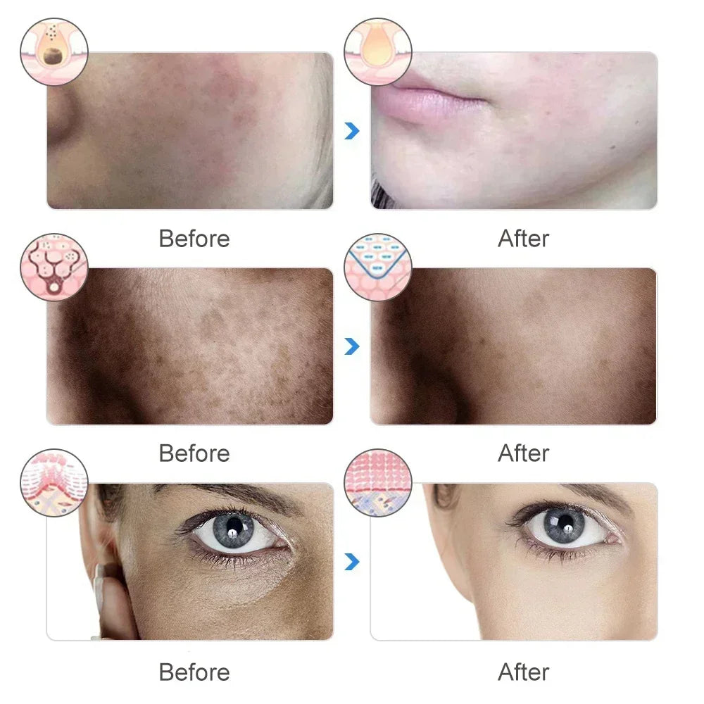 Masque LED Visage LAYAR – Thérapie Lumière Anti-Âge & Anti-Acné